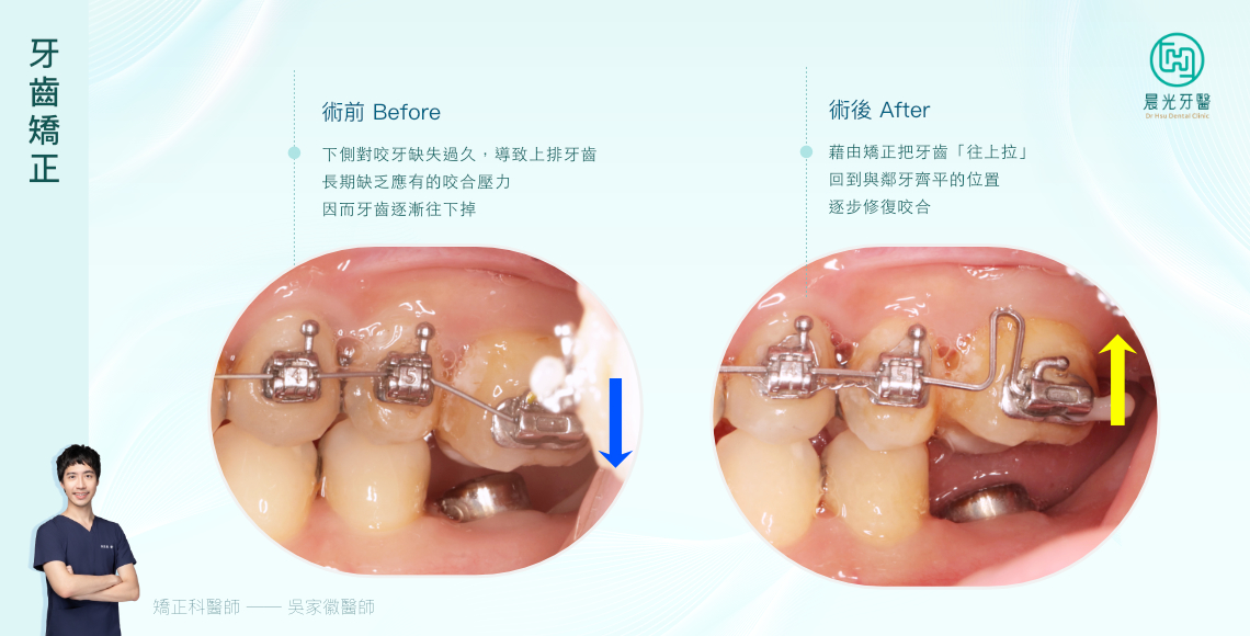 缺牙後遺症的完美逆轉